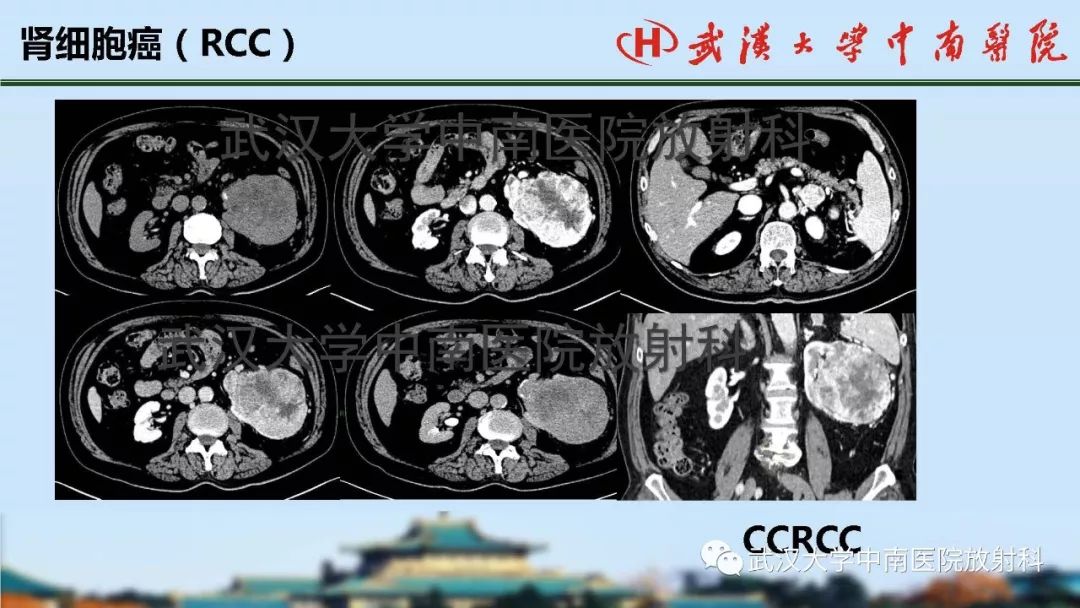 【PPT】肾脏解剖与实性肿瘤