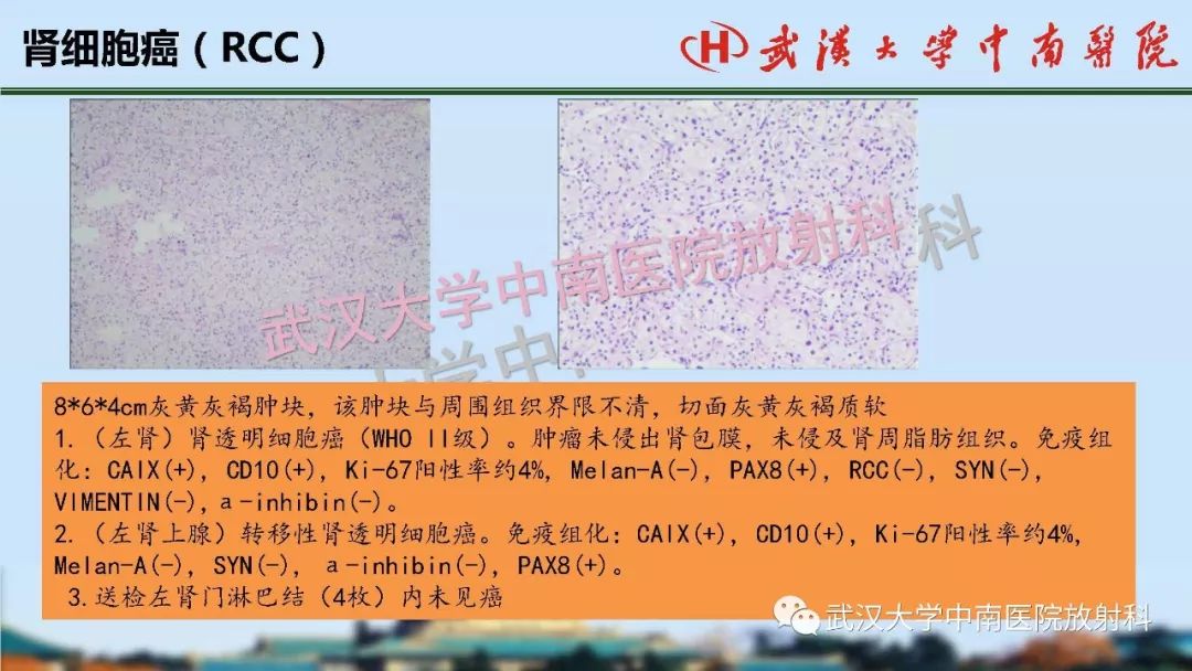 【PPT】肾脏解剖与实性肿瘤