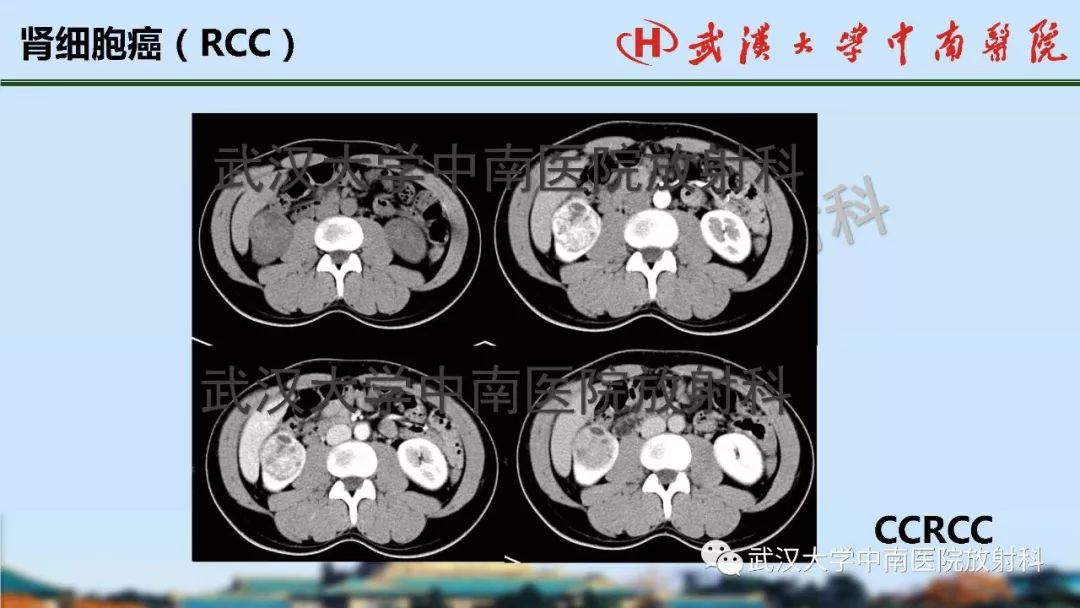 【PPT】肾脏解剖与实性肿瘤