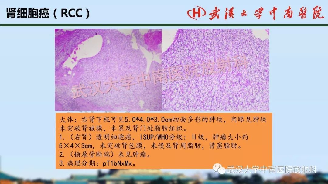 【PPT】肾脏解剖与实性肿瘤