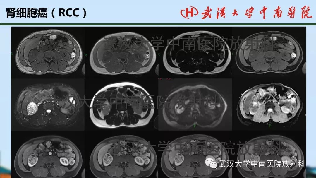 【PPT】肾脏解剖与实性肿瘤