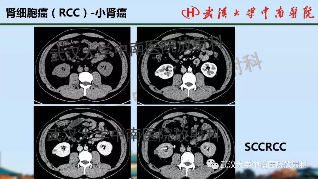 【PPT】肾脏解剖与实性肿瘤