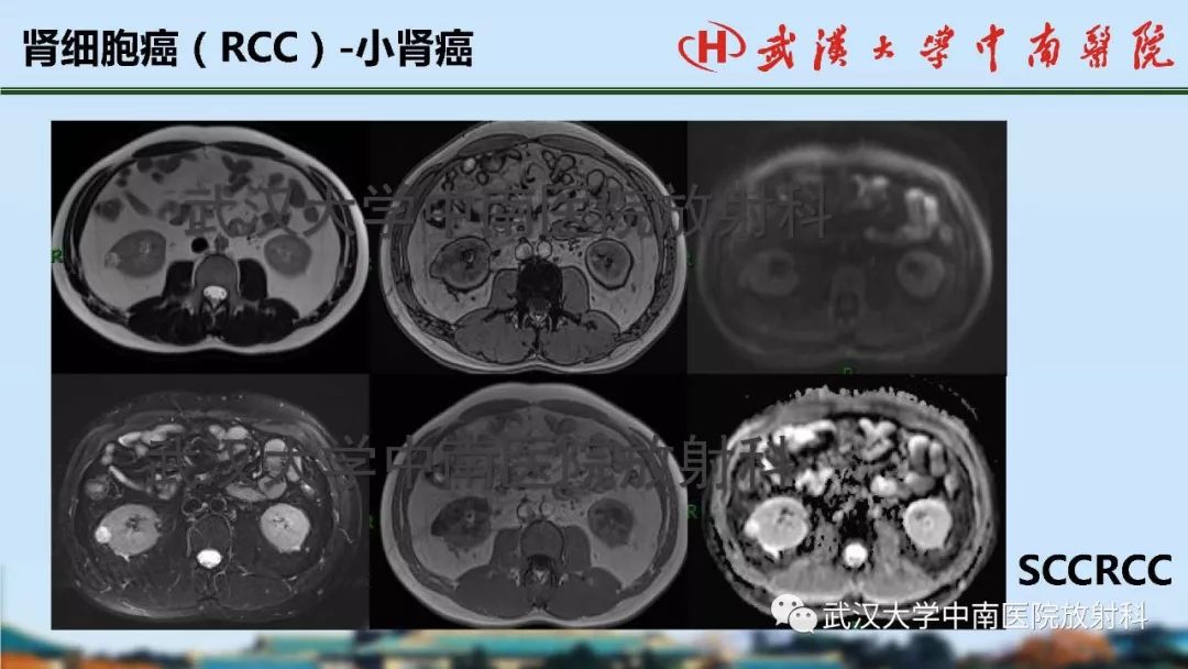 【PPT】肾脏解剖与实性肿瘤