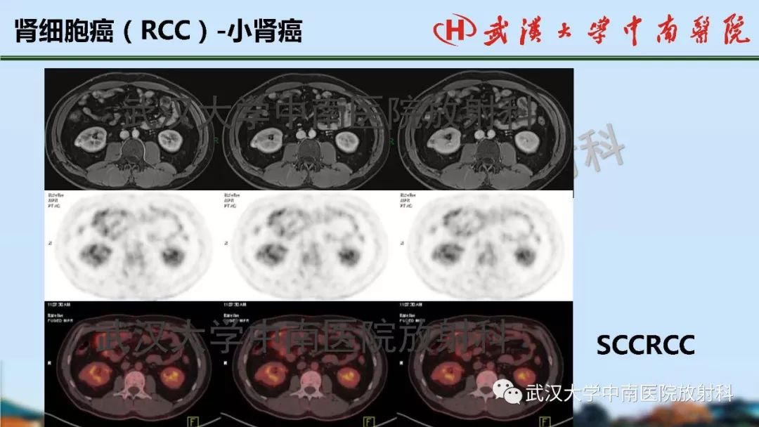 【PPT】肾脏解剖与实性肿瘤