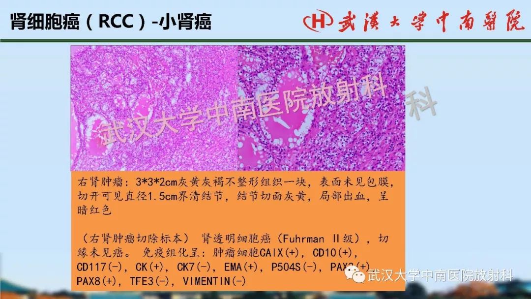 【PPT】肾脏解剖与实性肿瘤