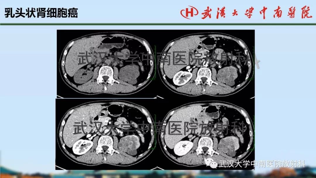 【PPT】肾脏解剖与实性肿瘤