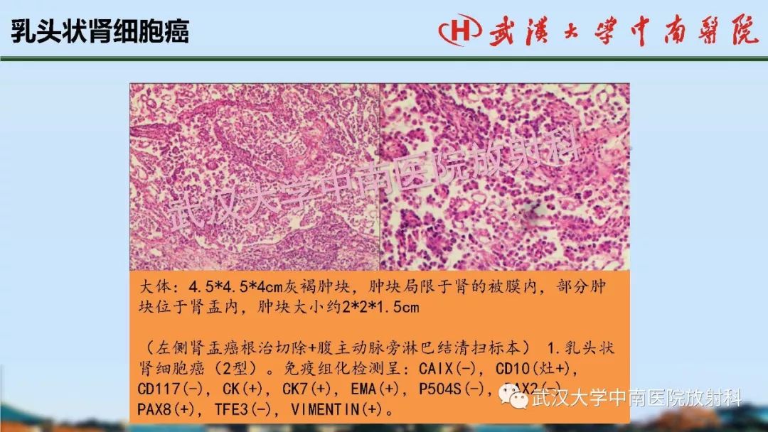 【PPT】肾脏解剖与实性肿瘤