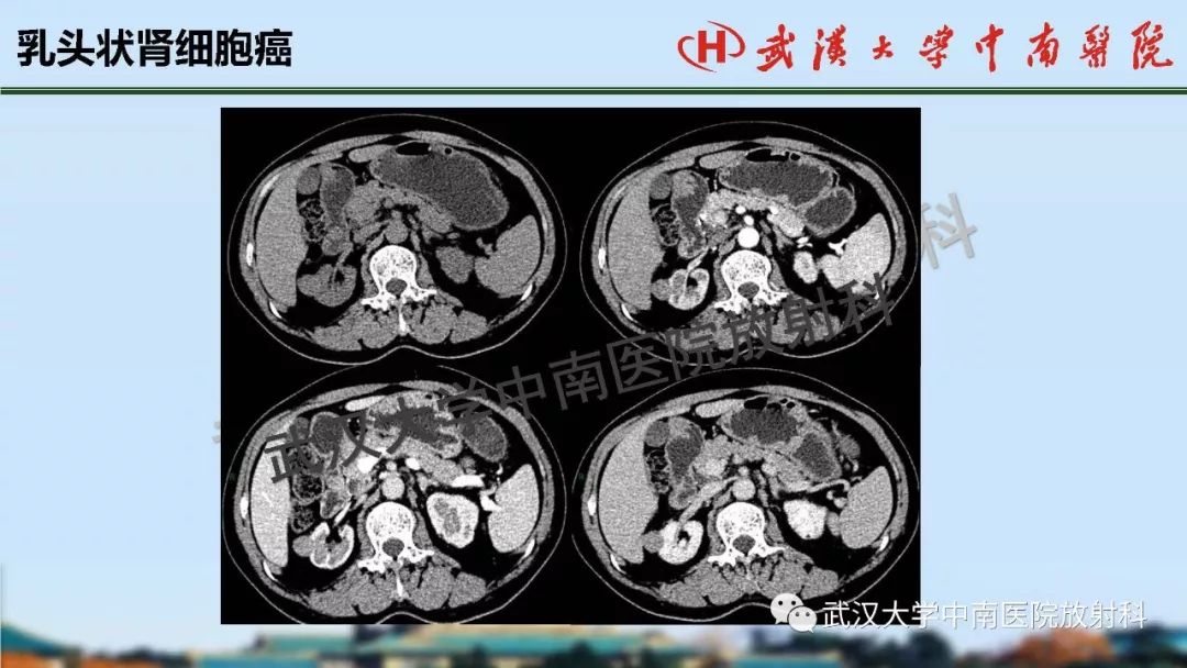 【PPT】肾脏解剖与实性肿瘤