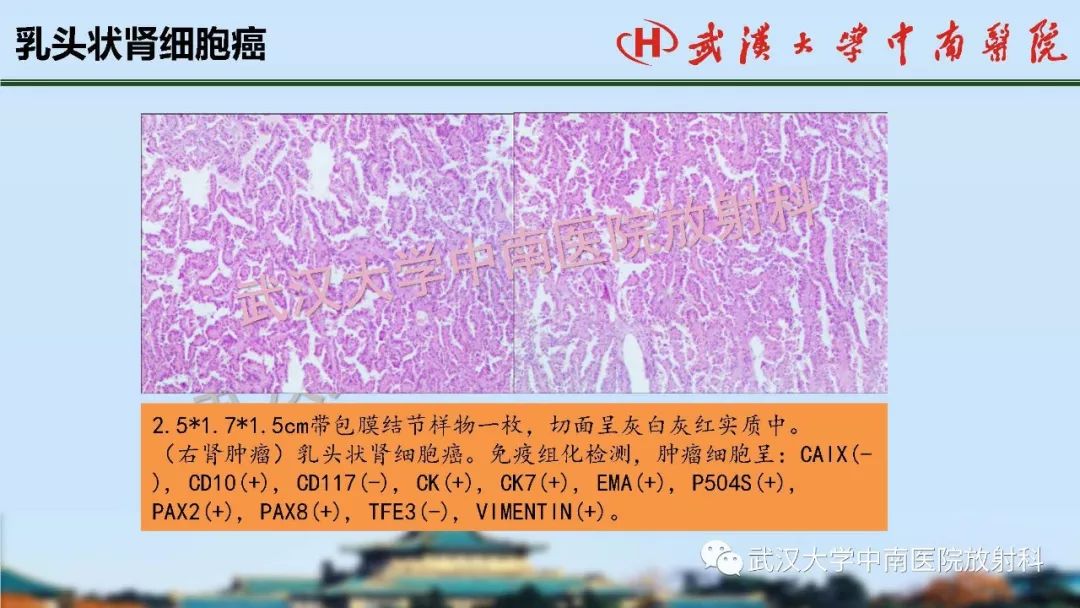 【PPT】肾脏解剖与实性肿瘤