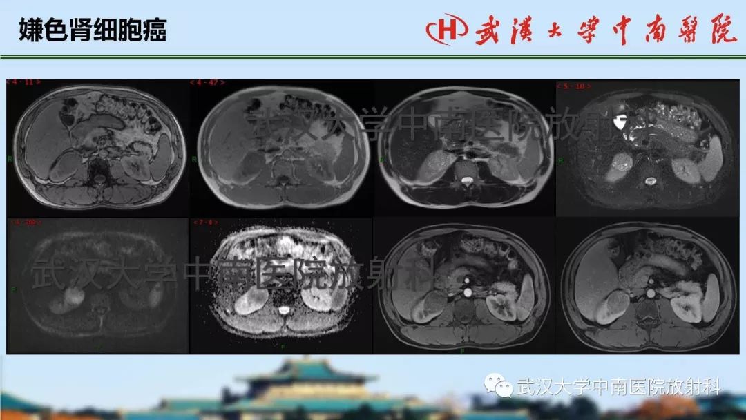 【PPT】肾脏解剖与实性肿瘤