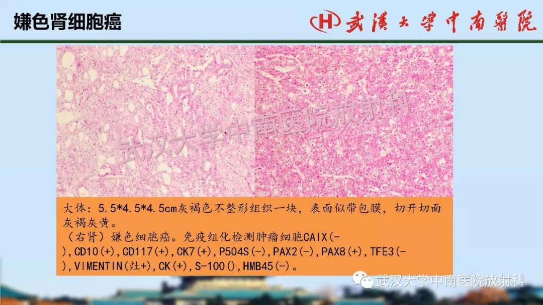 【PPT】肾脏解剖与实性肿瘤