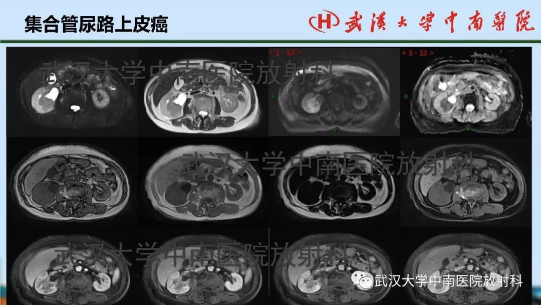 【PPT】肾脏解剖与实性肿瘤
