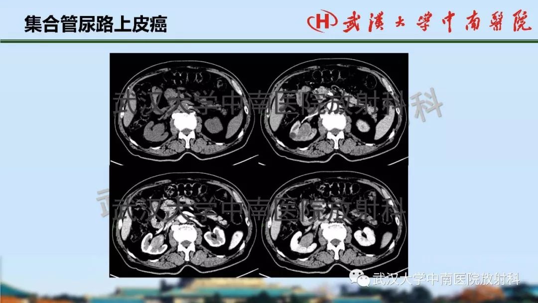 【PPT】肾脏解剖与实性肿瘤