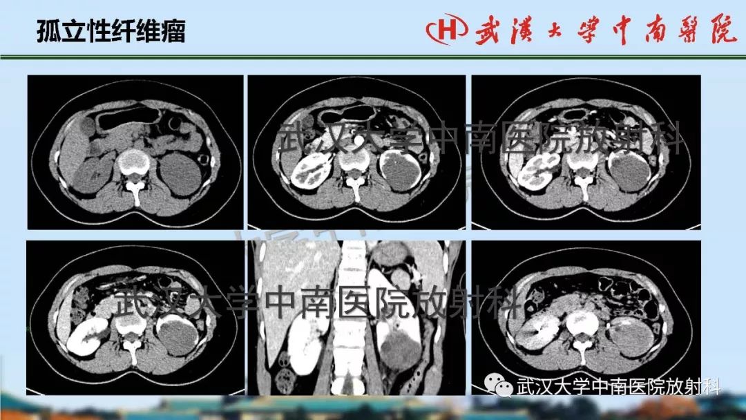 【PPT】肾脏解剖与实性肿瘤