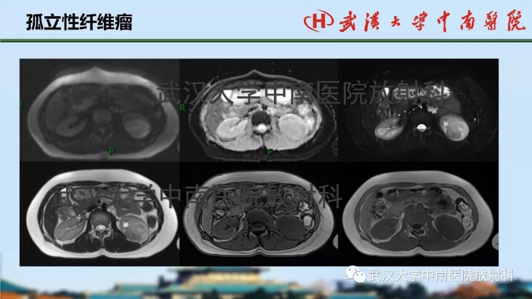 【PPT】肾脏解剖与实性肿瘤