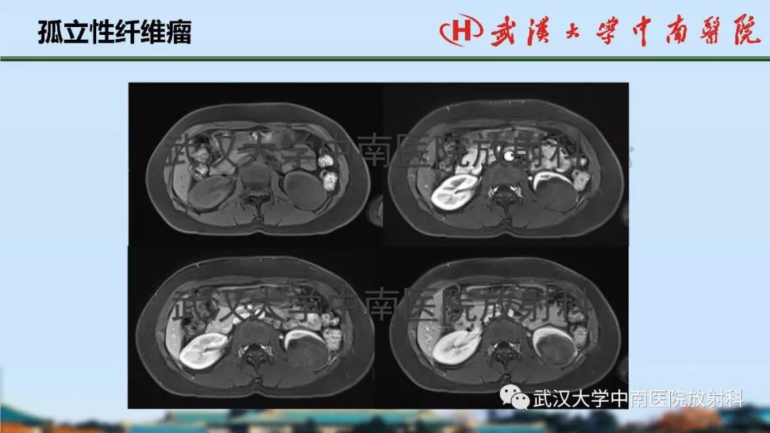 【PPT】肾脏解剖与实性肿瘤