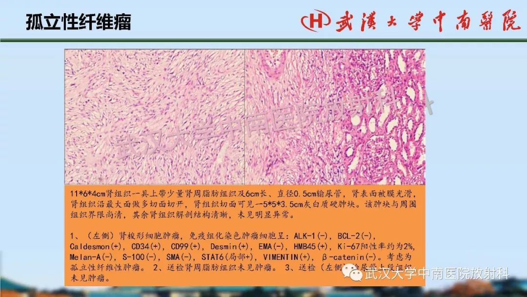 【PPT】肾脏解剖与实性肿瘤
