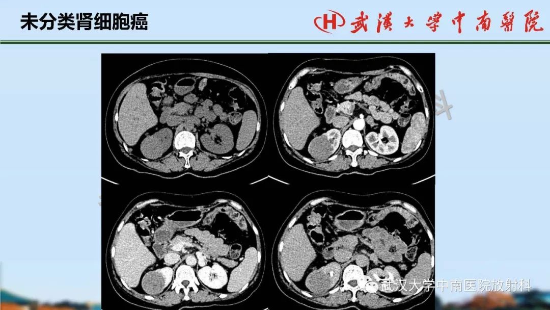 【PPT】肾脏解剖与实性肿瘤