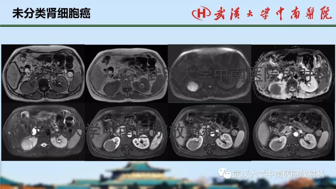 【PPT】肾脏解剖与实性肿瘤