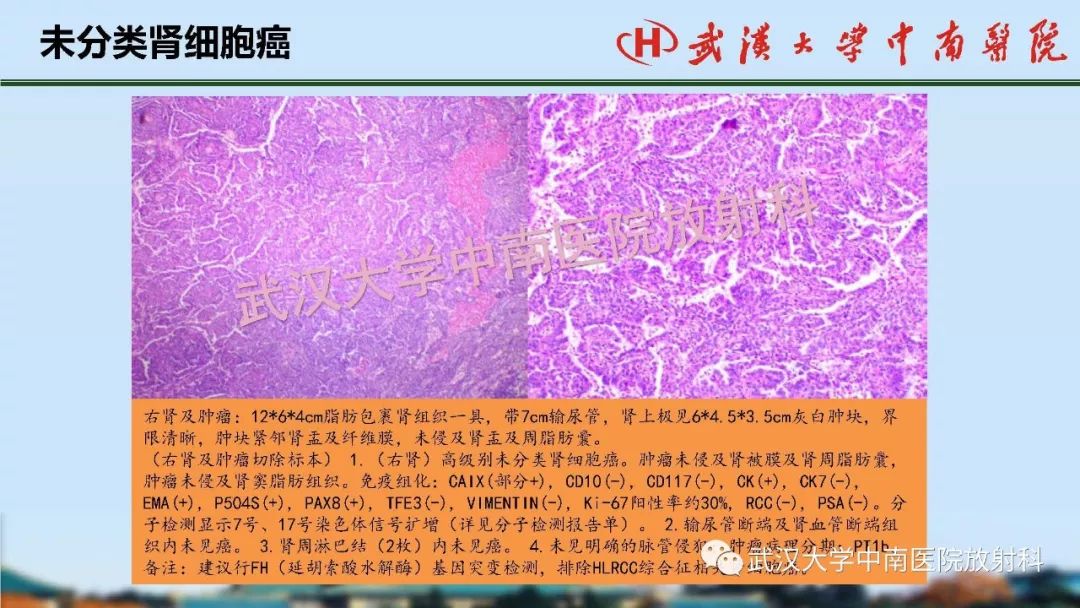 【PPT】肾脏解剖与实性肿瘤