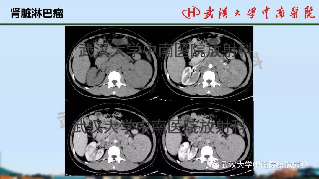 【PPT】肾脏解剖与实性肿瘤