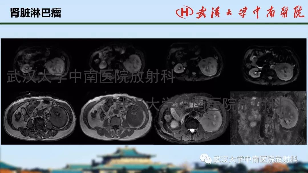 【PPT】肾脏解剖与实性肿瘤