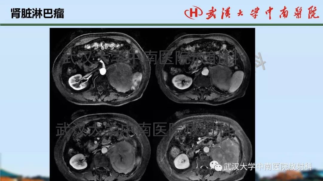 【PPT】肾脏解剖与实性肿瘤