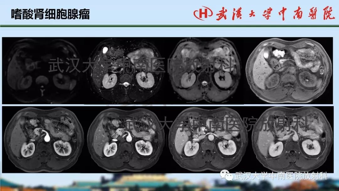 【PPT】肾脏解剖与实性肿瘤