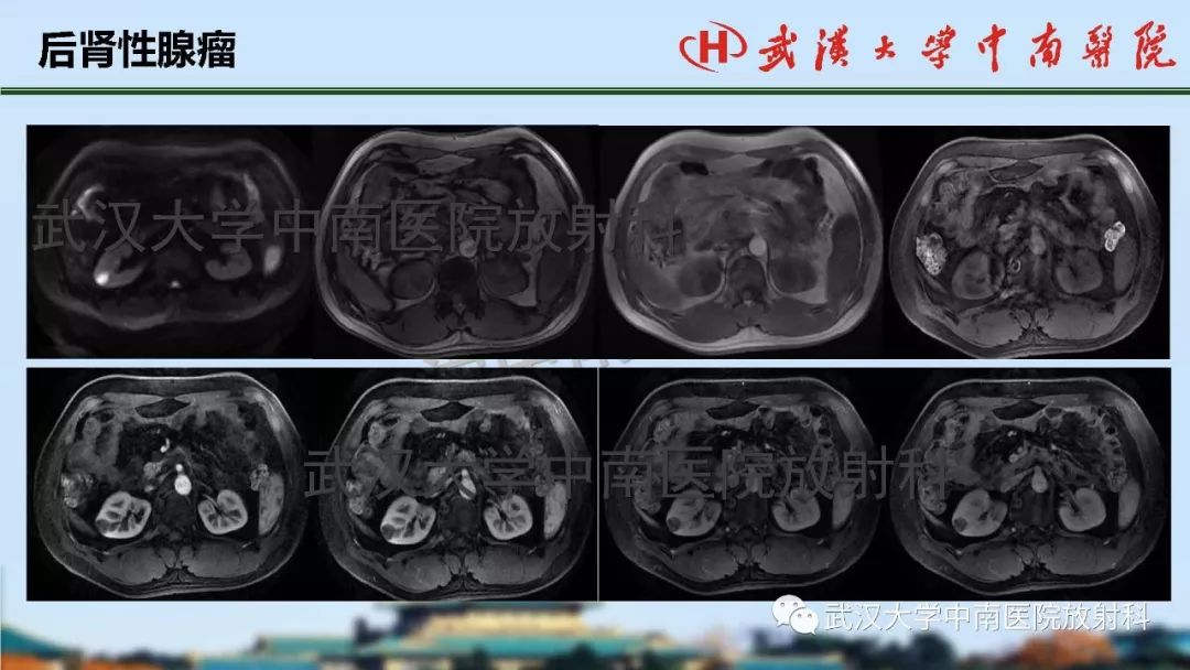 【PPT】肾脏解剖与实性肿瘤