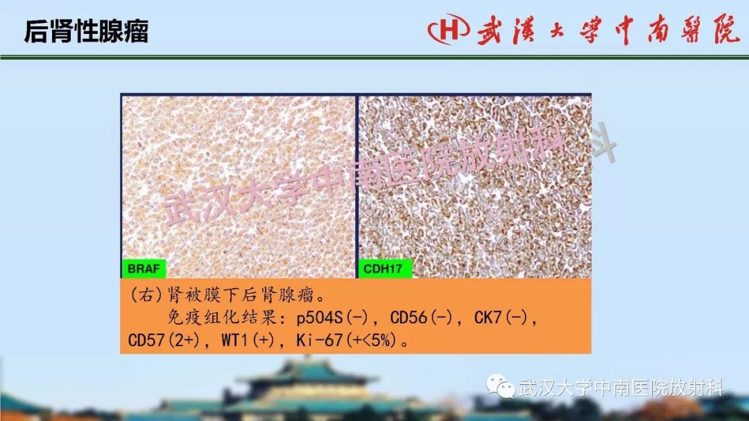 【PPT】肾脏解剖与实性肿瘤