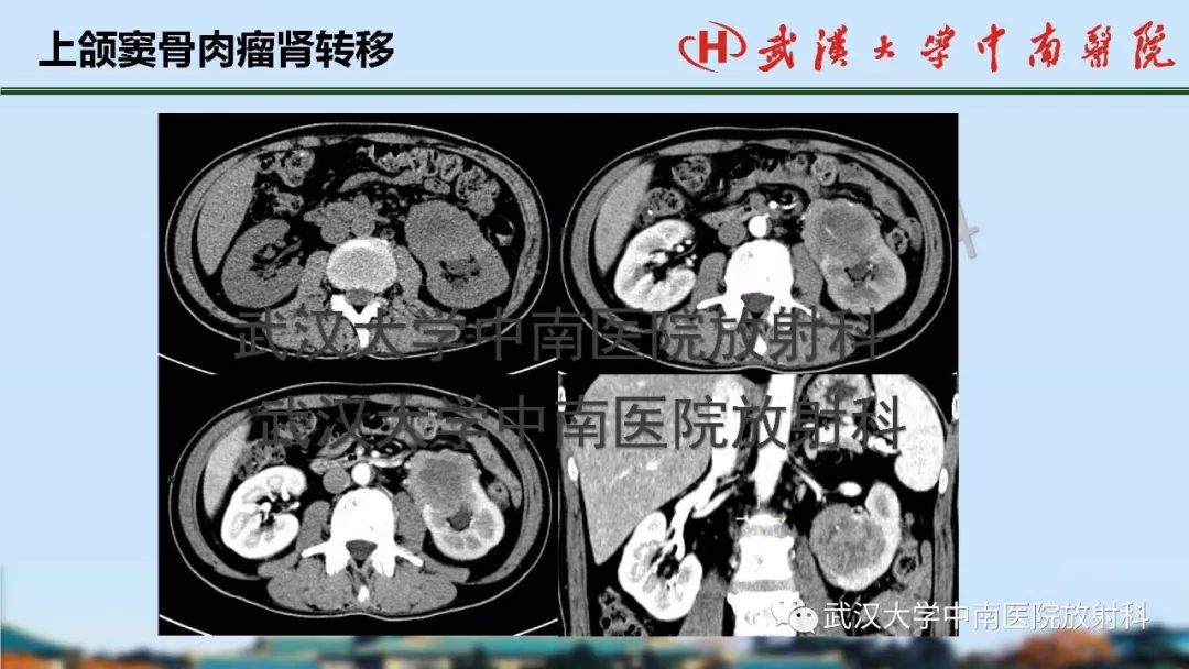 【PPT】肾脏解剖与实性肿瘤