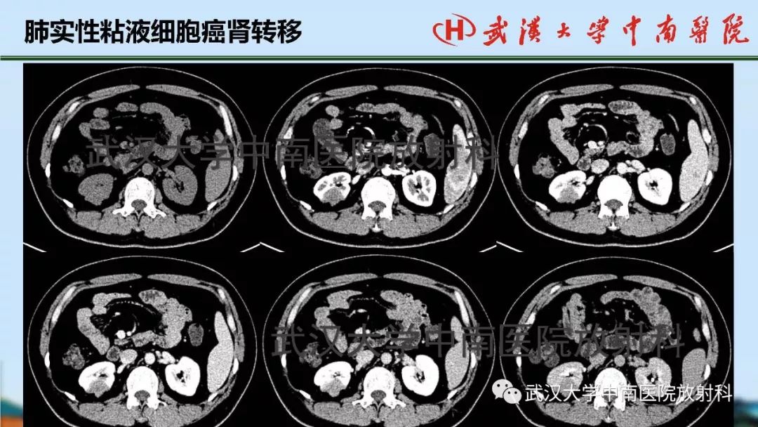 【PPT】肾脏解剖与实性肿瘤