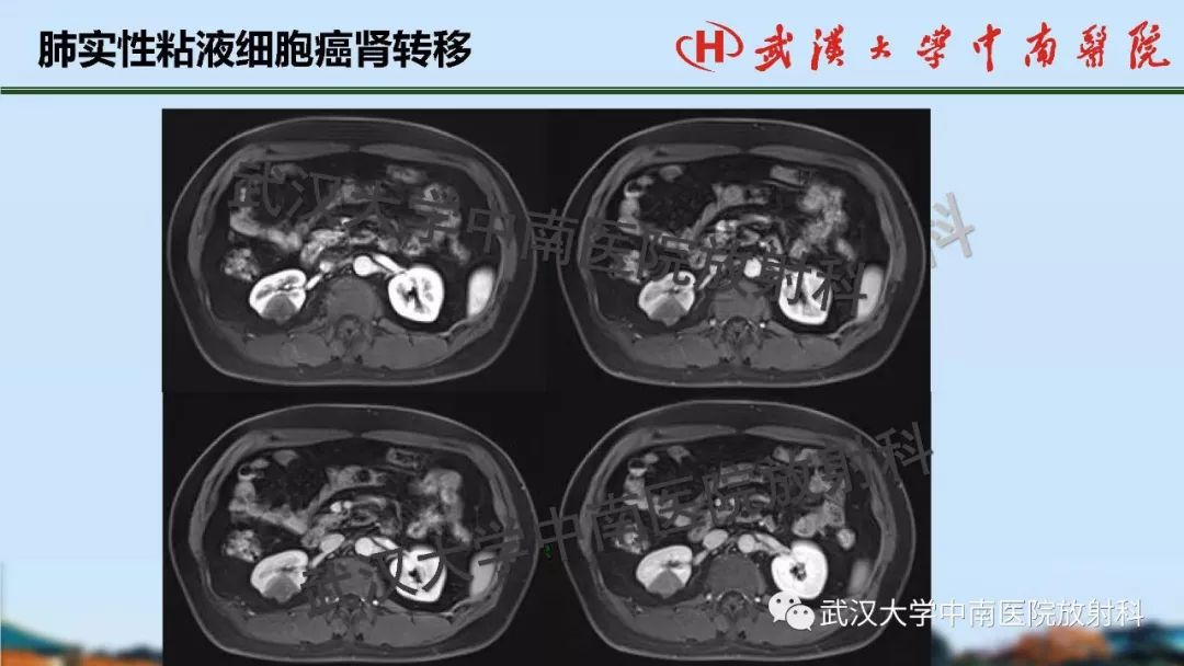 【PPT】肾脏解剖与实性肿瘤