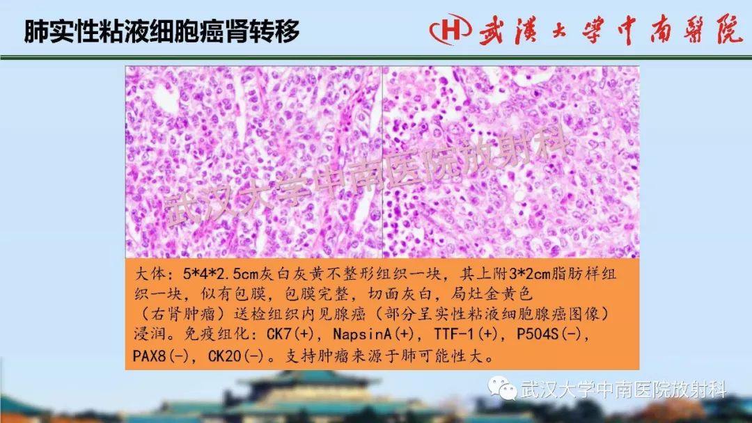 【PPT】肾脏解剖与实性肿瘤