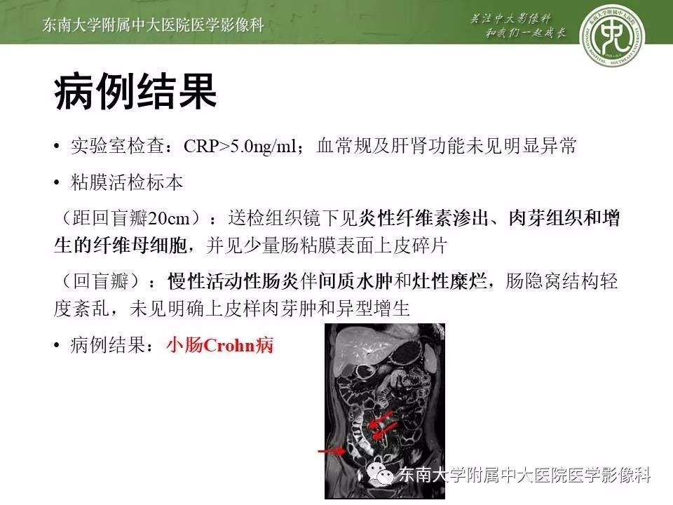 【PPT】炎症性肠病—克罗恩病的MRI表现
