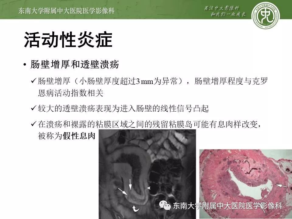 【PPT】炎症性肠病—克罗恩病的MRI表现