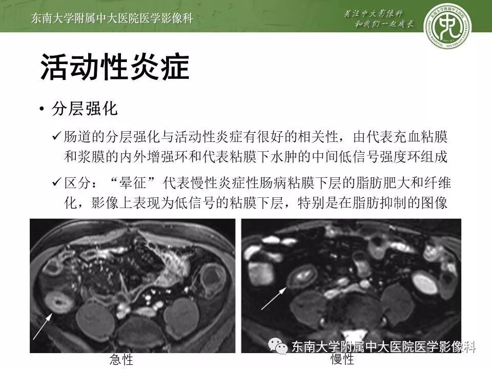 【PPT】炎症性肠病—克罗恩病的MRI表现