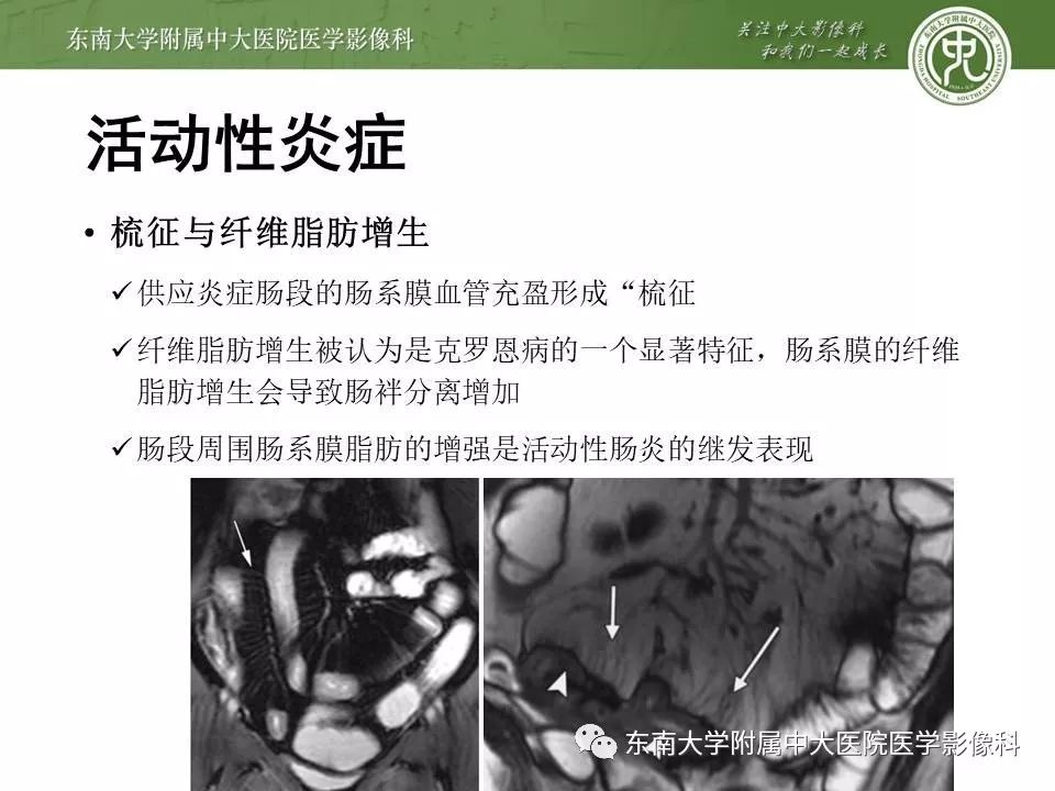 【PPT】炎症性肠病—克罗恩病的MRI表现