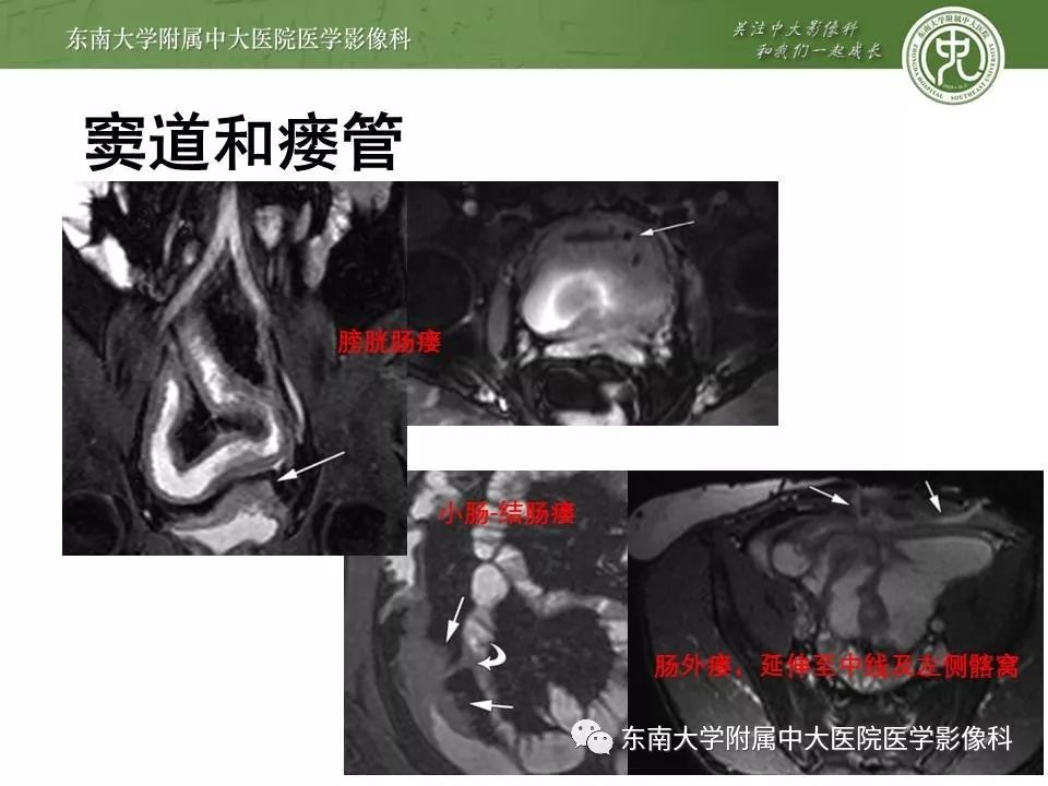 【PPT】炎症性肠病—克罗恩病的MRI表现