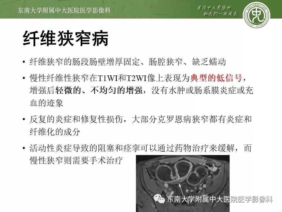 【PPT】炎症性肠病—克罗恩病的MRI表现