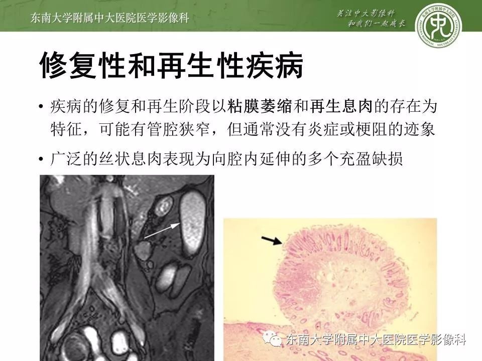 【PPT】炎症性肠病—克罗恩病的MRI表现