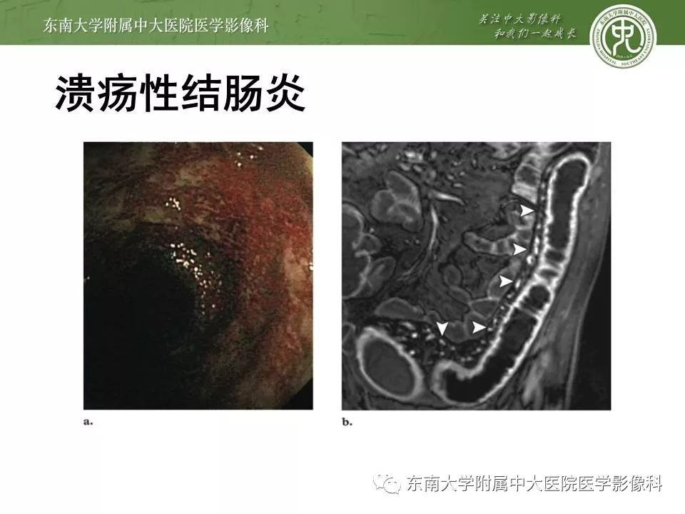 【PPT】炎症性肠病—克罗恩病的MRI表现