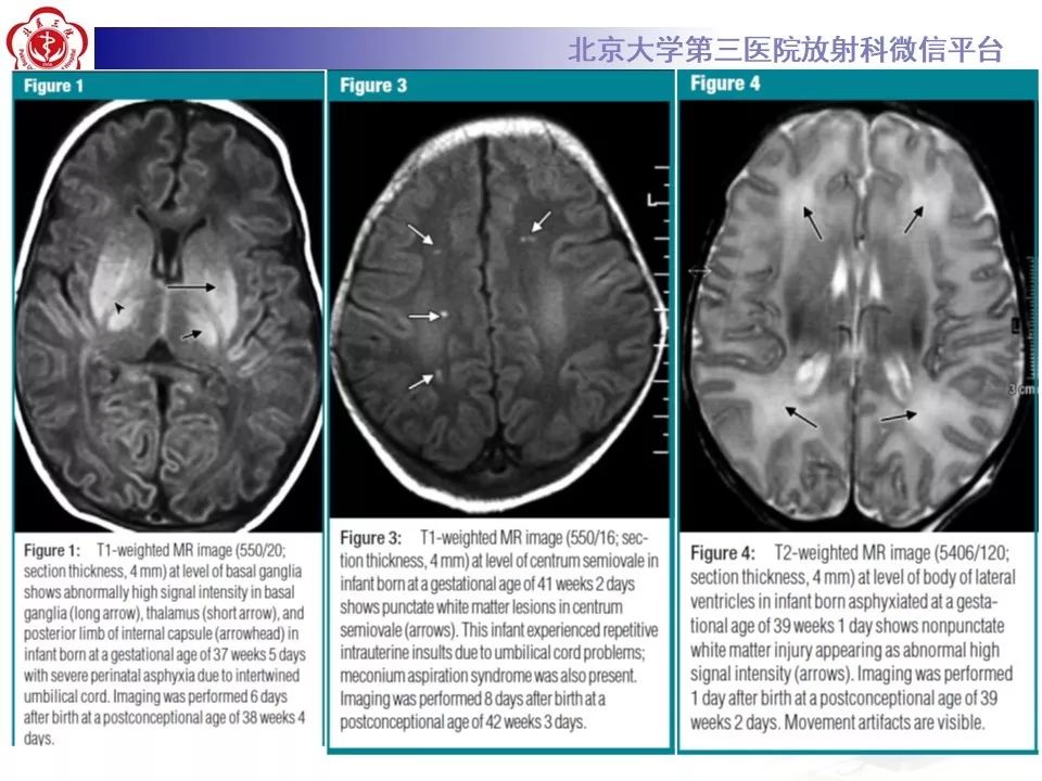 【PPT】新生儿缺氧缺血性脑病HIE的影像