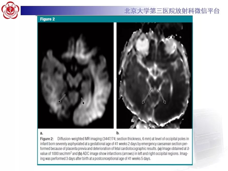 【PPT】新生儿缺氧缺血性脑病HIE的影像