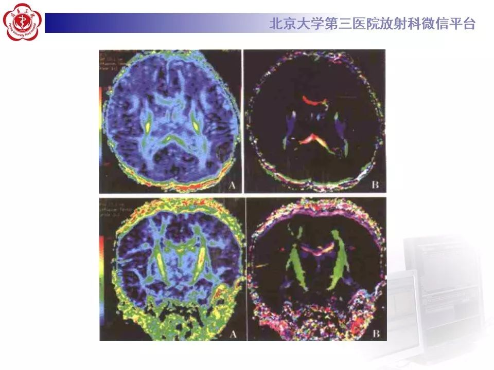 【PPT】新生儿缺氧缺血性脑病HIE的影像
