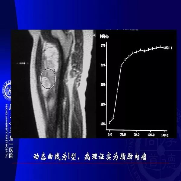 【PPT】MRI诊断软组织肿瘤研究思考