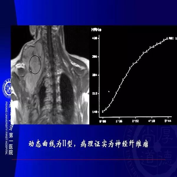 【PPT】MRI诊断软组织肿瘤研究思考