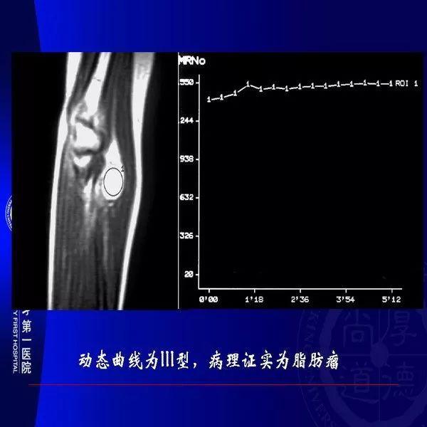 【PPT】MRI诊断软组织肿瘤研究思考