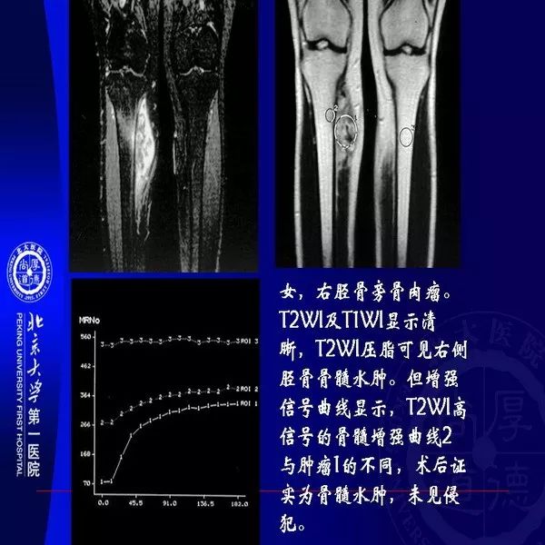 【PPT】MRI诊断软组织肿瘤研究思考