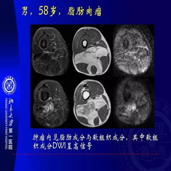 【PPT】MRI诊断软组织肿瘤研究思考